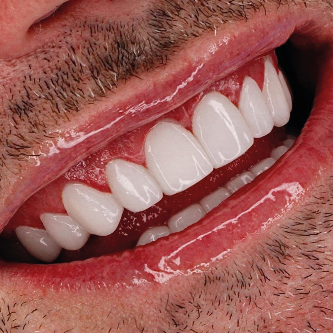 Detalle de diseño de sonrisa — resultado Smile On