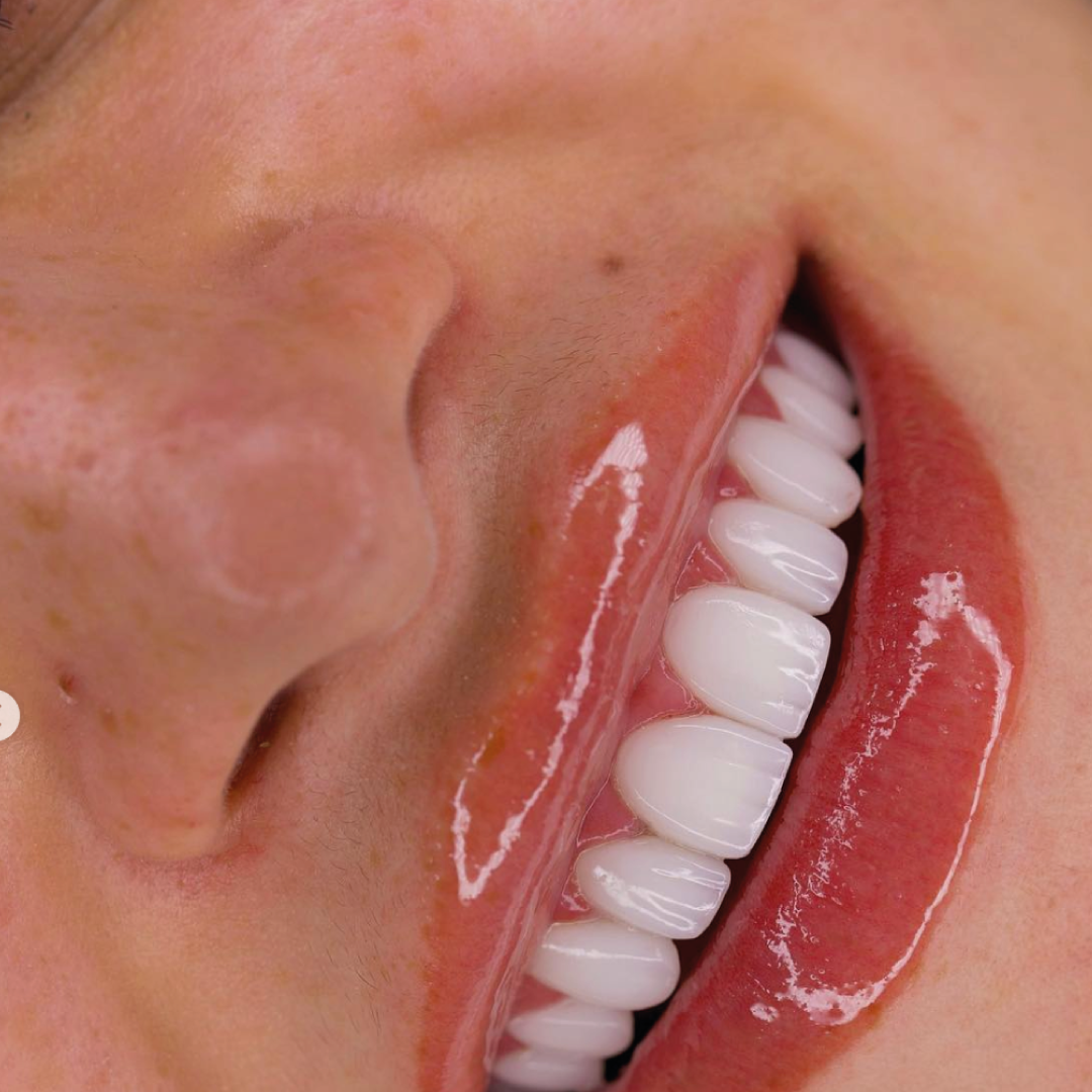 Detalle de diseño de sonrisa — resultado Smile On