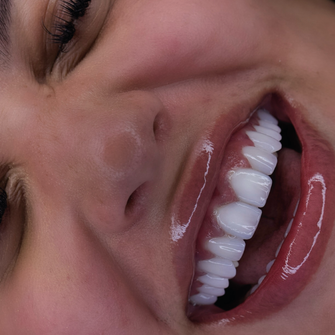 Detalle de diseño de sonrisa — resultado Smile On